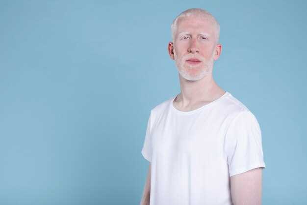 Альбиносы: кто они и что такое альбинизм?