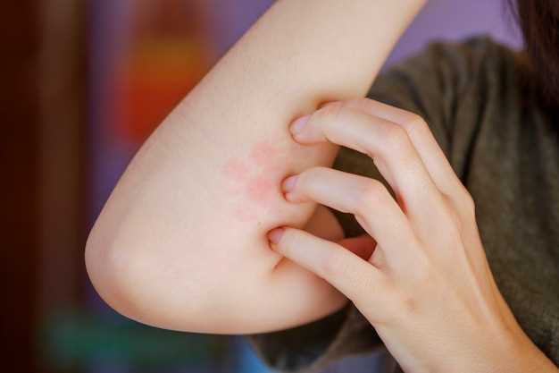 Аллергический васкулит: причины, симптомы, диагностика и лечение