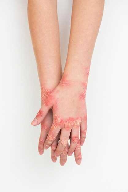 Дисгидротическая экзема: симптомы и лечение пальцев рук